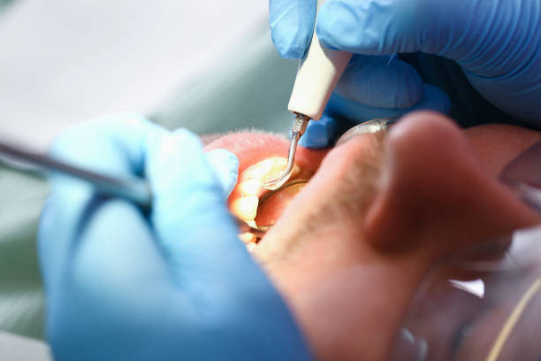 Best Broken or Chipped Tooth Repair in Independence, OH