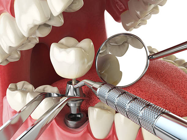 Best Broken or Chipped Tooth Repair in Independence, OH